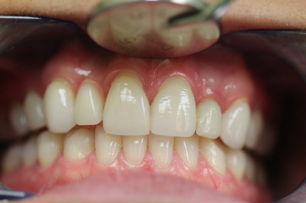 Routine Dental Treatment